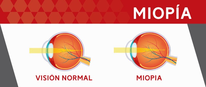 Corrección de la miopía: ojo normal y ojo con miopía