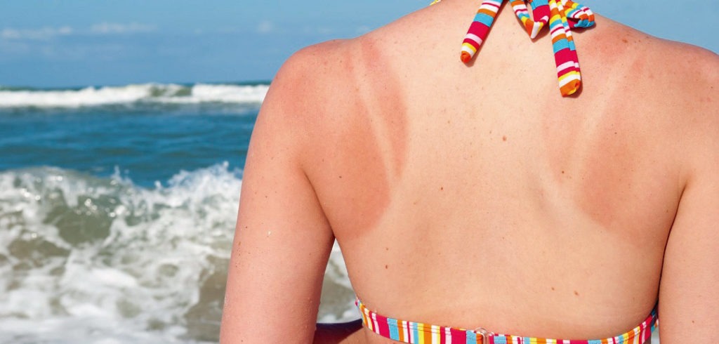 Salud de la piel: quemadura de sol