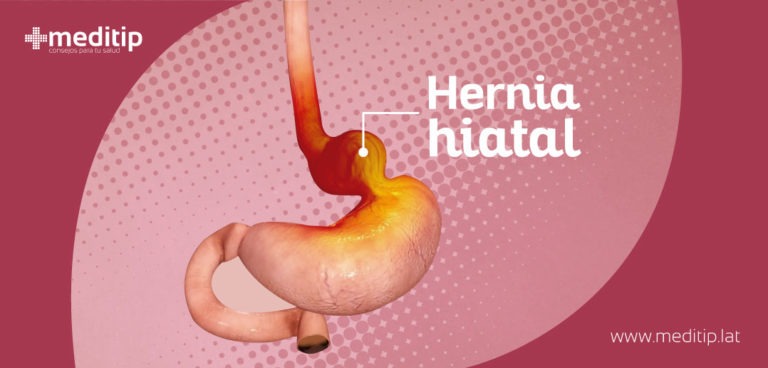 Hernia Hiatal Tipos Causas Síntomas Y Tratamiento