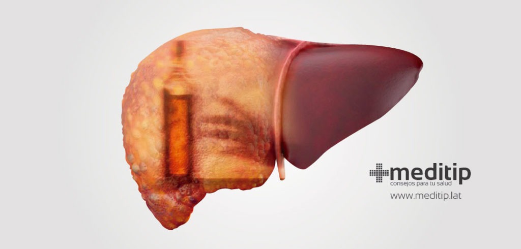 Función del hígado: hepatitis alcohólica