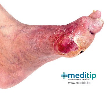 Prevención del pie diabético: pie con úlceras