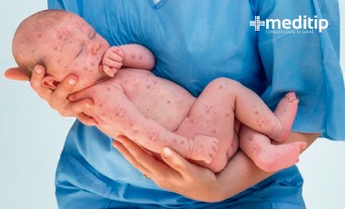 Brote de sarampión: bebé con sarampión