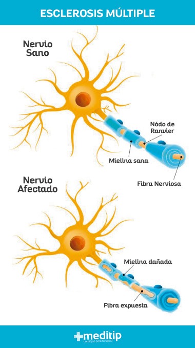 Causas de la esclerosis múltiple: daño en la mielina