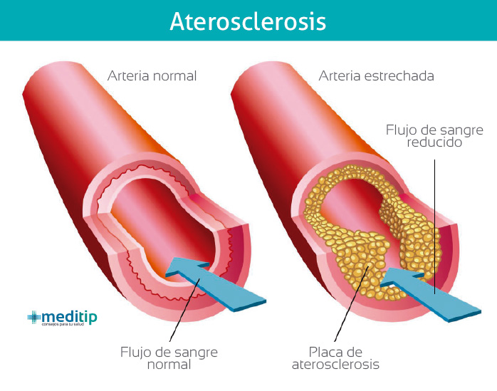 Causas de la aterosclerosis: formación de placa en las arterias