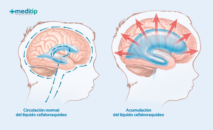 Causas de la hidrocefalia: acumulación de líquido en el cerebro