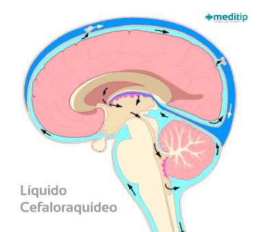 Causas de la hidrocefalia: líquido cefalorraquídeo