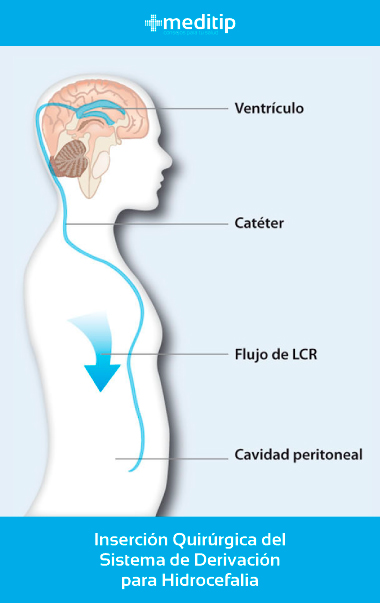 Causas de la hidrocefalia: sistema de derivación ventriculoperitoneal, válvula de hidrocefalia