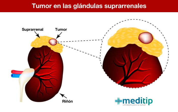 Hiperaldosteronismo: tumor en las glándulas suprarrenales
