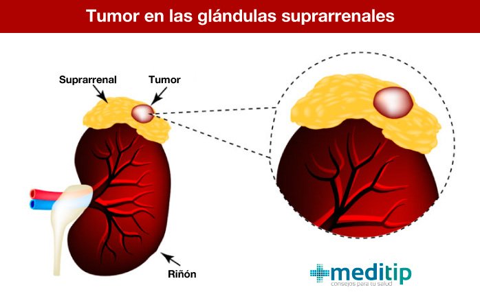 Hiperaldosteronismo Causas Diagn stico Y Tratamiento Meditip Hiperaldosteronismo Causas Diagn stico Y Tratamiento Meditip